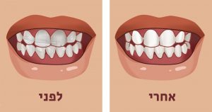 8 מאכלי על לחיזוק השיניים ולמניעת שחיקתן