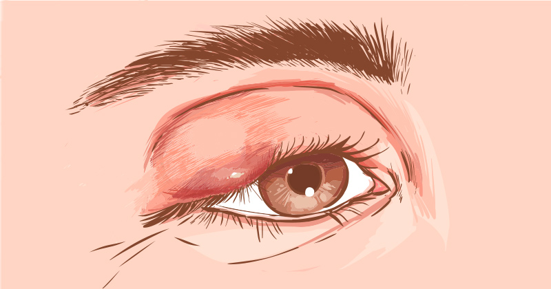 שעורה בעין, מה היא בדיוק? וטיפולים טבעיים