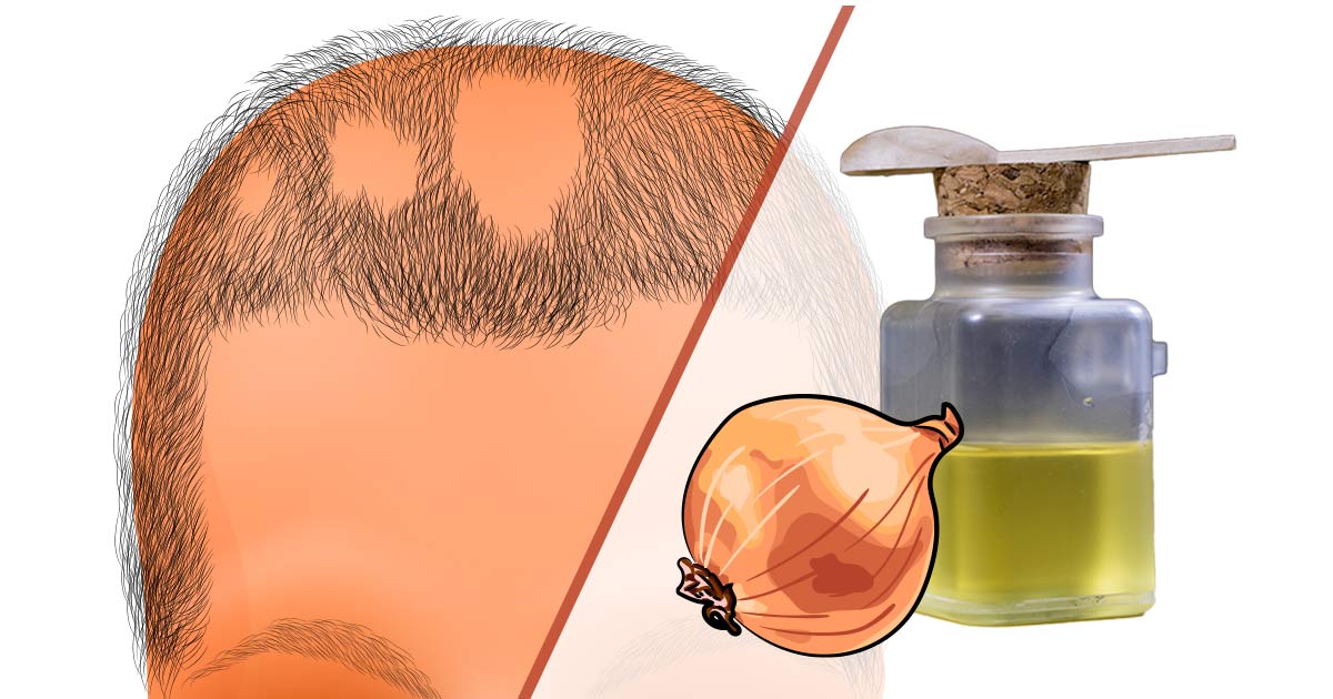 אלופציה אראטה - הטיפולים הטבעיים שבאמת עובדים