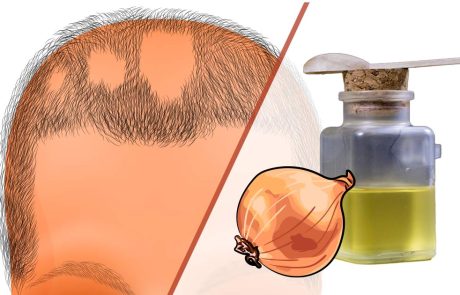 אלופציה אראטה - הטיפולים הטבעיים שבאמת עובדים