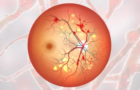 רטינופתיה סוכרתית - הסיבוך שכל חולה סוכרת צריך להכיר