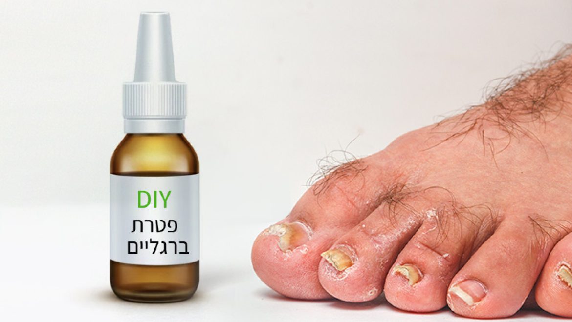 פטרת ברגליים, מתכון לספריי טבעי וקל להכנה