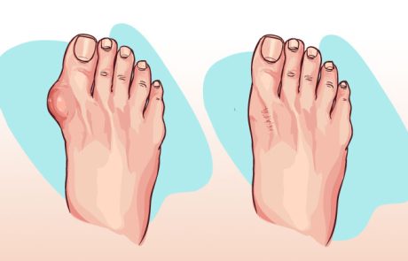 מה זה בוניון וכיצד להיפטר מזה!