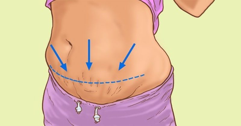 5 סימנים לכך שאתם לא שמנים, אלא רק הבטן שלכם נפוחה
