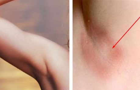 9 סיבות הגורמות לגירוי בבית השחי ודרכים טבעיות לטפל בהם