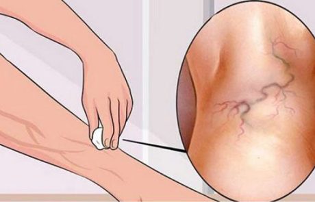 כך תיפטרו מורידים ברגלים בעזרת מרכיב אחד שיש לכולנו במטבח