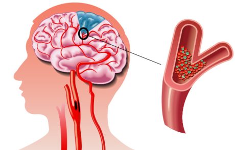 חומצה פולית (פולאט) חשיבותה לבריאות ומקורות טבעיים