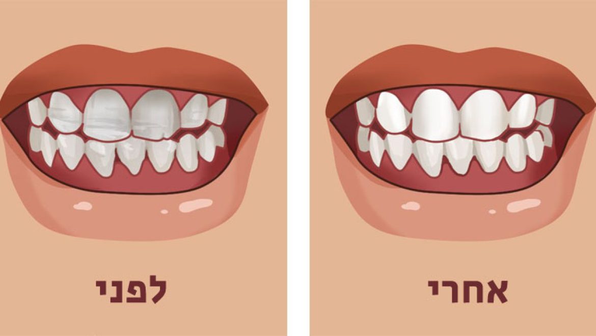 8 מאכלי על לחיזוק השיניים ולמניעת שחיקתן