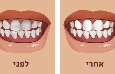 8 מאכלי על לחיזוק השיניים ולמניעת שחיקתן