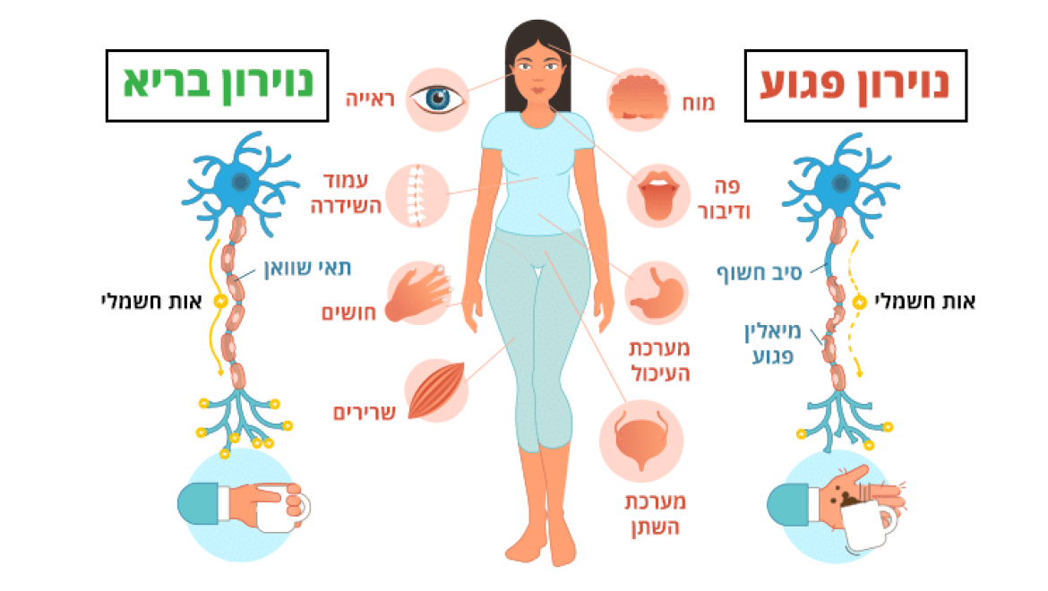 טרשת נפוצה, 5 טיפים שיסייעו לכם להקל על התסמינים