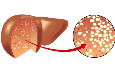 כבד שומני מה זה? תסמינים וטיפול ומניעה טבעיים