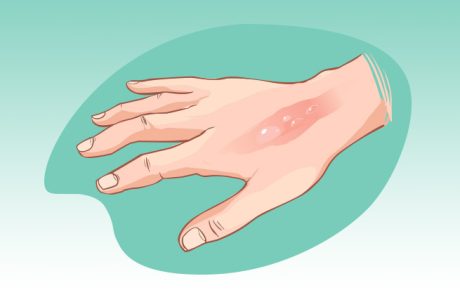 כוויות, 5 מהטיפולים הטבעיים והיעילים ביותר