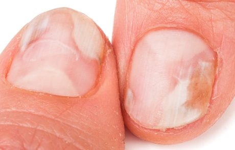 כתמים לבנים בציפורניים - משמעות, זיהוי ואופני טיפול