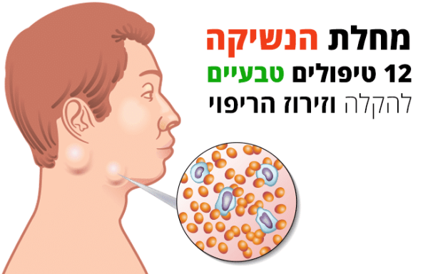 מחלת הנשיקה, 12 טיפולים טבעיים להקלה וזירוז הריפוי