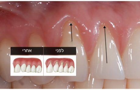כך תעצרו נסיגת חניכיים ותאיצו את צמיחתן מחדש