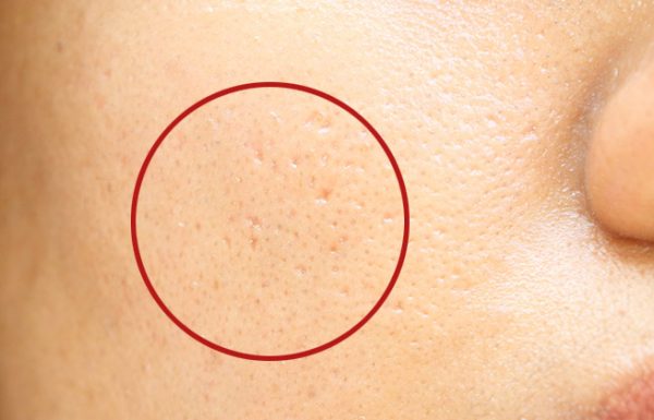 6 דרכים קלות ופשוטות שיסגרו לכם את הנקבוביות הפעורות על העור