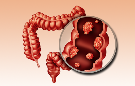 10 סימני אזהרה של סרטן המעי הגס שאסור להתעלם מהם!