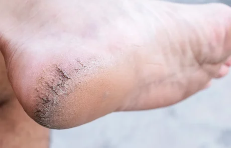 עקבים סדוקים ויבשים, הגורמים העיקריים ומה עושים כדי לרכך אותם