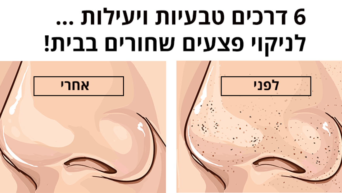 6 דרכים טבעיות ויעילות לניקוי פצעים שחורים בבית