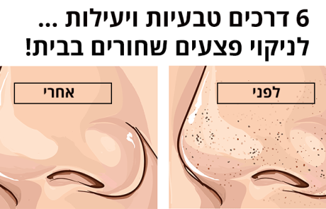 6 דרכים טבעיות ויעילות לניקוי פצעים שחורים בבית