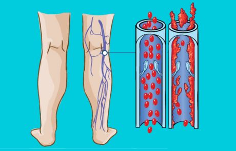 4 תסמינים של פקקת ורידים עמוקה שאתם חייבים לדעת!