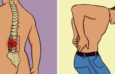 פריצת דיסק - טיפולים טבעיים מומלצים