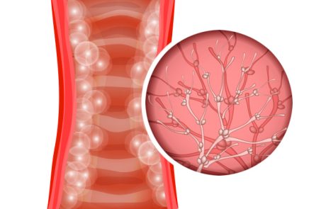 קנדידה, 10 מזונות למניעה וטיפול בזיהומי שמרים