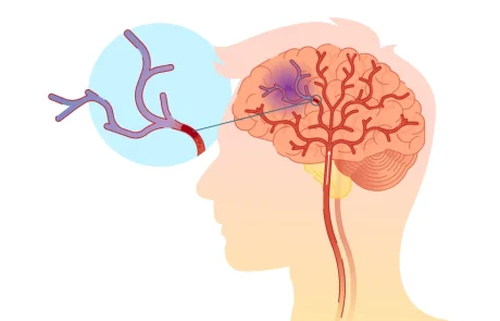 שבץ (אירוע מוחי) 14 מזונות שמפחיתים את הסיכון להתרחשותו