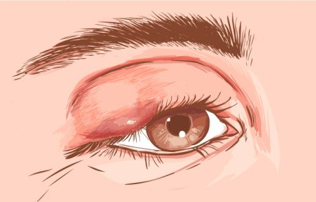 שעורה בעין, מה היא בדיוק? וטיפולים טבעיים